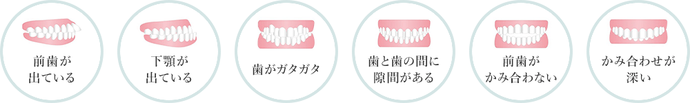 前歯が出ている・下顎が出ている・歯がガタガタ・歯と歯の間に隙間がある・前歯がかみ合わない・かみ合わせが深い