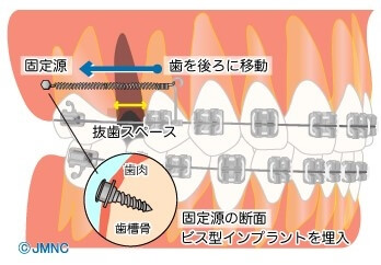 歯科矯正用アンカースクリューを用いた治療